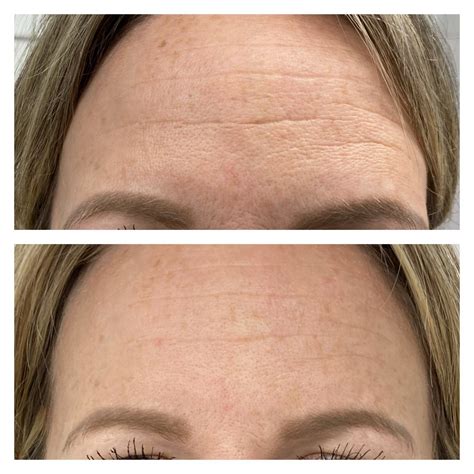 3 microneedling sessions before and after