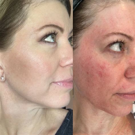 before and after pictures of microneedling