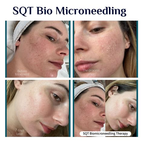 bio microneedling