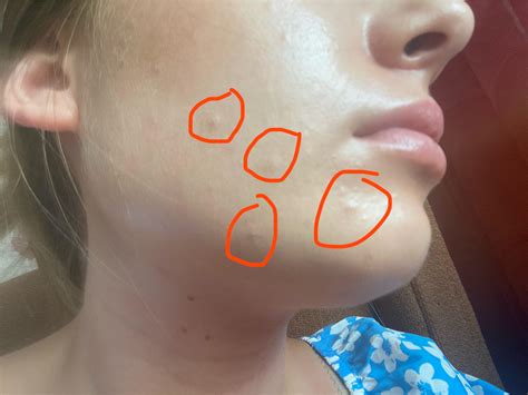 breaking out after microneedling