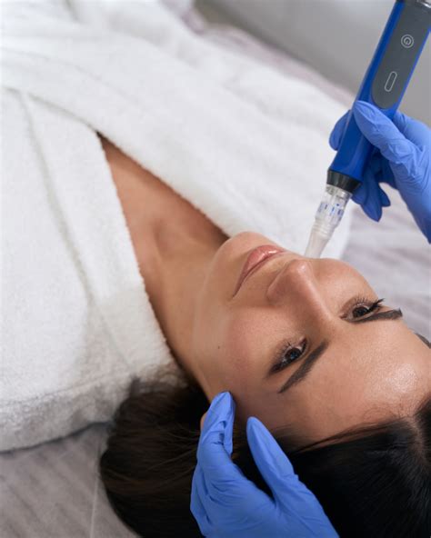 can microneedling cause acne