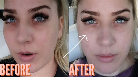 dark circles microneedling under eyes before and after