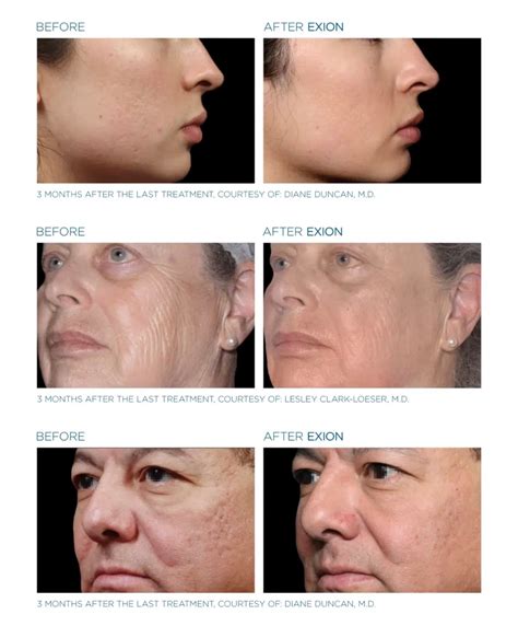 exion microneedling