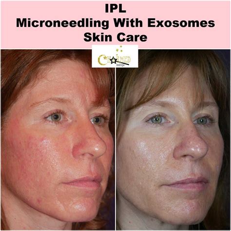 exosomes microneedling