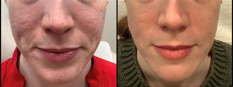 genius microneedling before and after