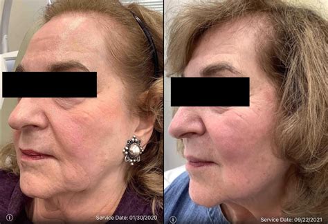 genius rf microneedling before and after