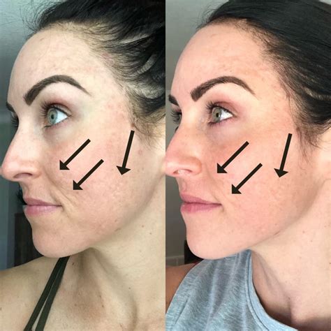 how often can i do microneedling