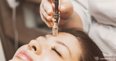 how often can you get microneedling