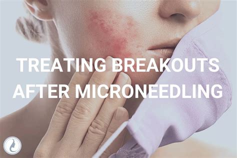 how to treat breakouts after microneedling