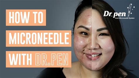 how to use microneedle pen