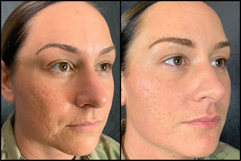 images of microneedling before and after