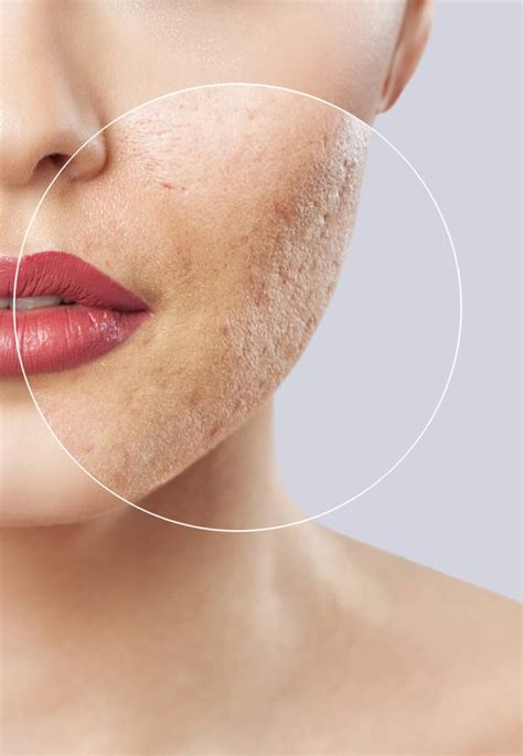 intracel microneedling