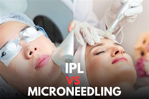 ipl vs microneedling