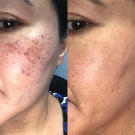 is microneedling permanent