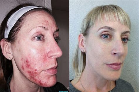 microneedling albuquerque