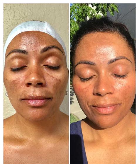 microneedling and melasma