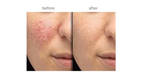 microneedling and rosacea