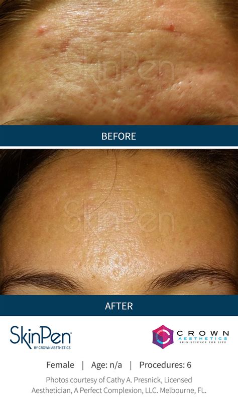 microneedling atlanta ga