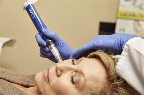 microneedling buffalo ny