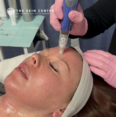 microneedling charlotte nc