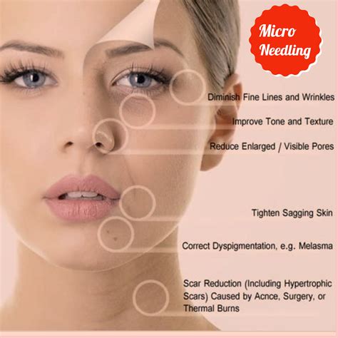 microneedling contraindications