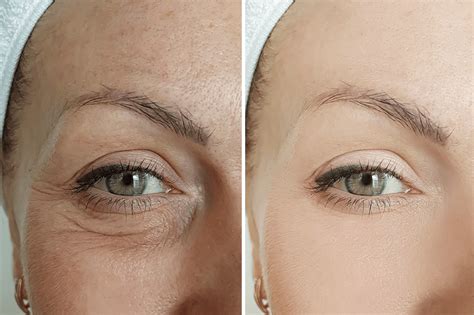 microneedling eyelids before and after