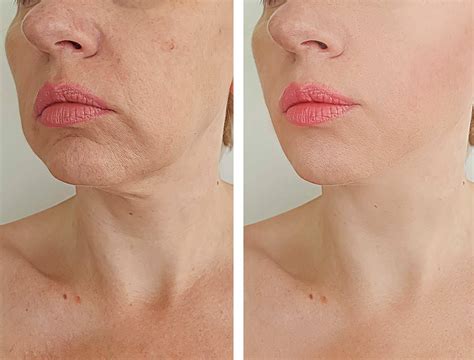 microneedling for jowls