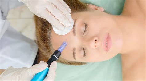 microneedling in san diego