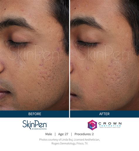 microneedling jacksonville fl