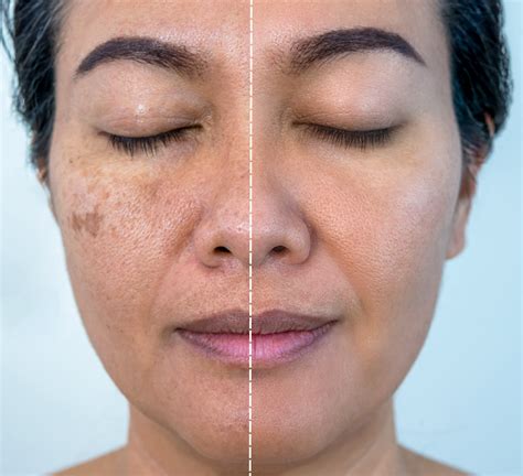 microneedling melasma