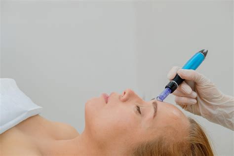 microneedling naples fl