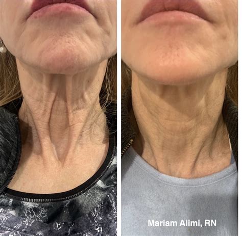 microneedling neck before and after