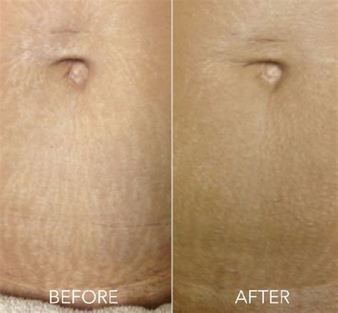 microneedling on stomach