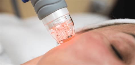 microneedling phoenix az