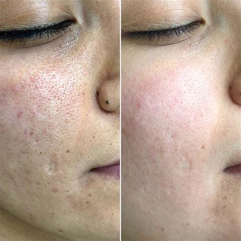 microneedling pores before and after