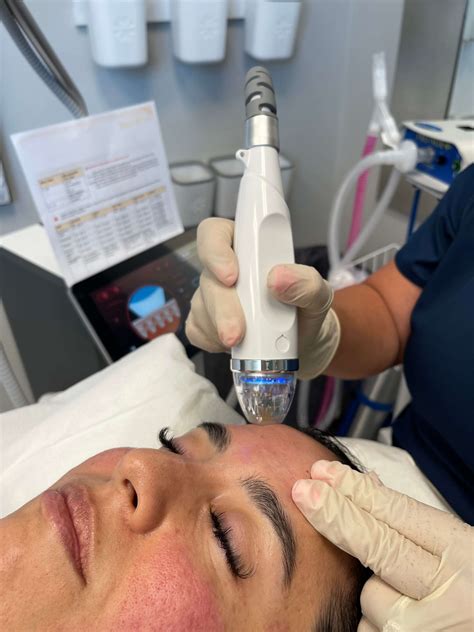 microneedling san antonio tx