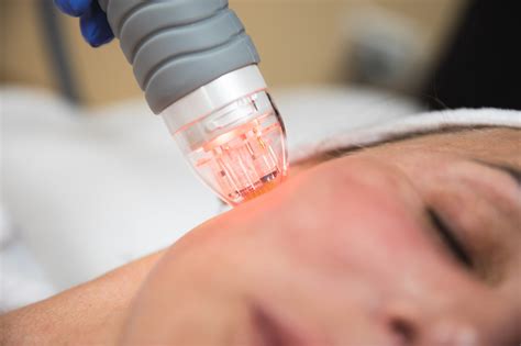 microneedling services