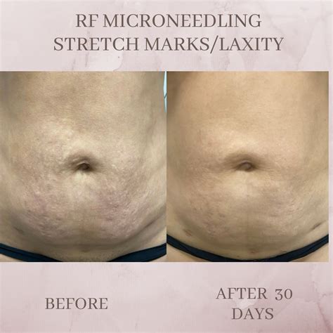 microneedling stomach before and after