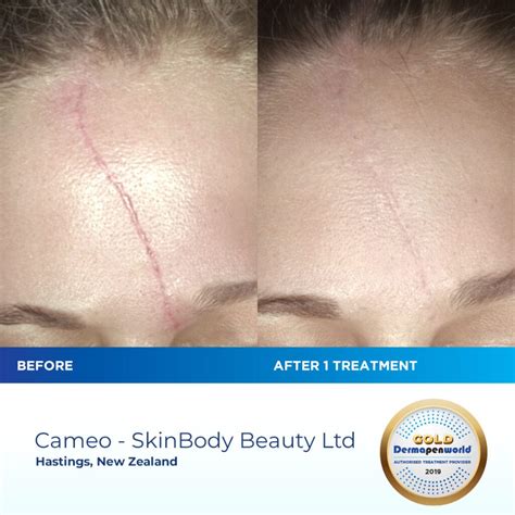 microneedling surgical scars before and after