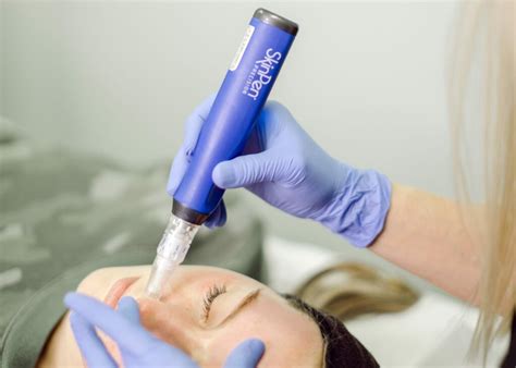 microneedling tampa fl