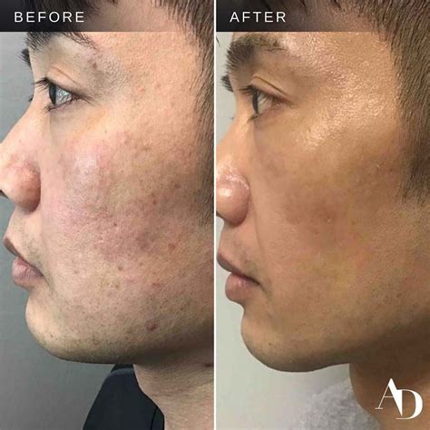 microneedling with chemical peel