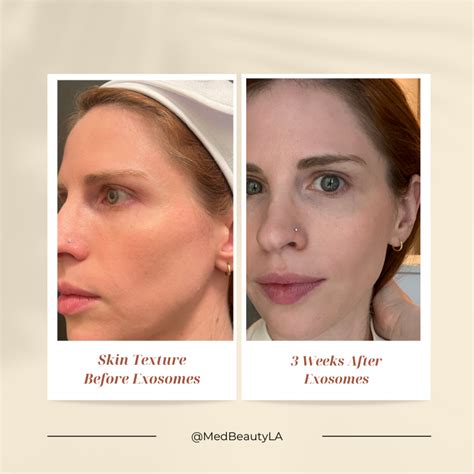 microneedling with exosomes before and after