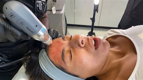 pixel8 rf microneedling