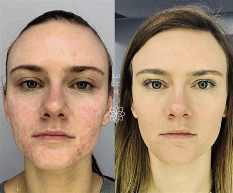 prf microneedling before and after