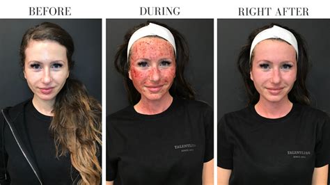 red light therapy after microneedling