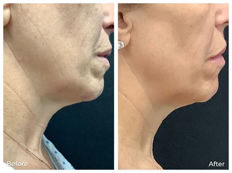 rf microneedling before and after neck