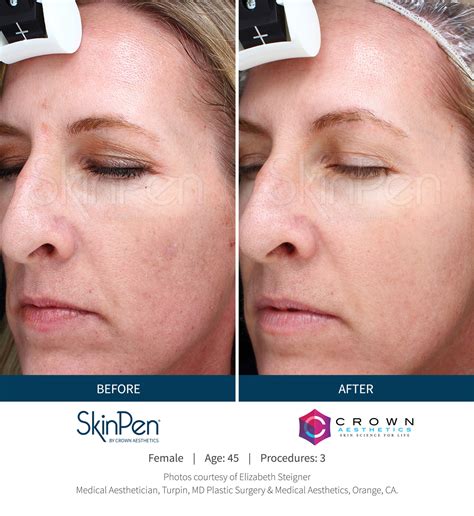 skin pen microneedling before and after