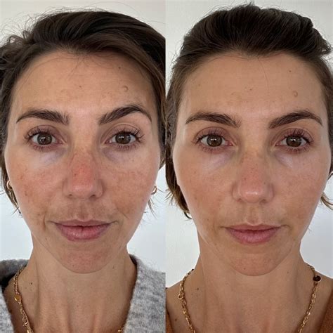 skinpen microneedling before and after