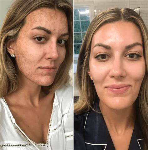 under eyes gone wrong microneedling before and after 1 treatment