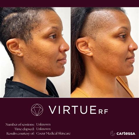 virtue rf microneedling before and after